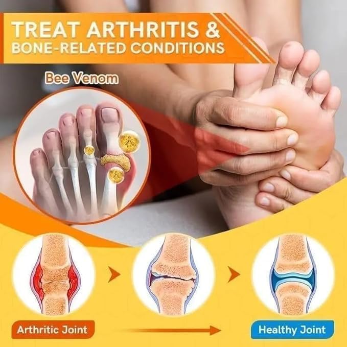 Bees Venom Spray Natural Relief For Varicose Veins & Spider Veins (Pack Of 3)_zankhi