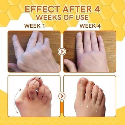 Bees Venom Spray Natural Relief For Varicose Veins & Spider Veins (Pack Of 3)_zankhi