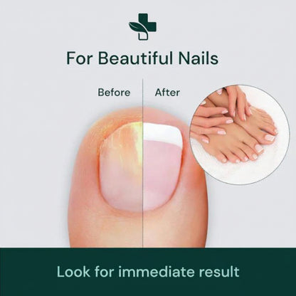 Nail Serum for Nail Repair for Damage, Growth, Fungle Infaction (Pack Of 2)